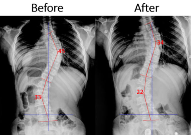 Scoliosis img